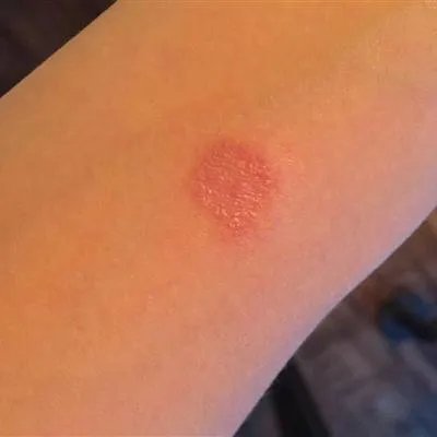 虫咬有什么症状