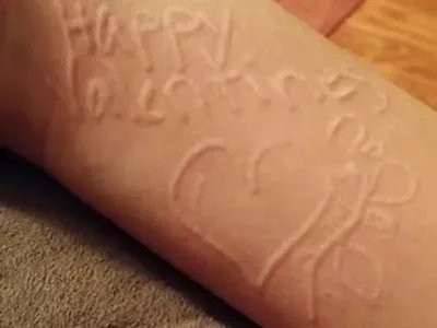 人工荨麻疹症状图片