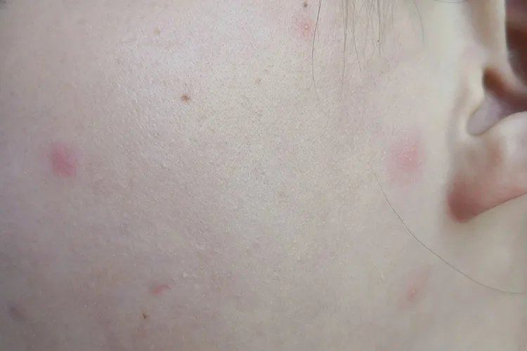 初期水痘的症状和治疗图片