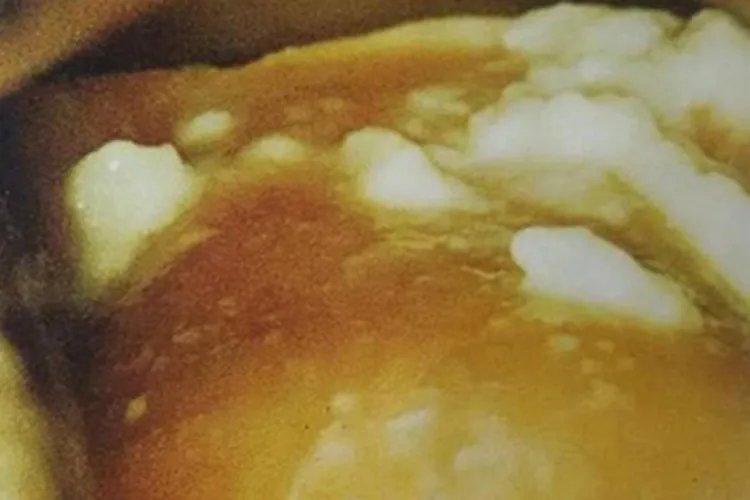 外阴阴道念珠菌病豆腐渣白带图片