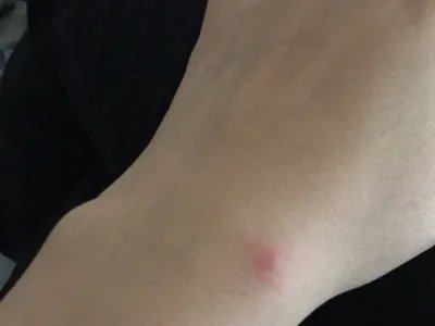 跳蚤叮咬疙瘩图片