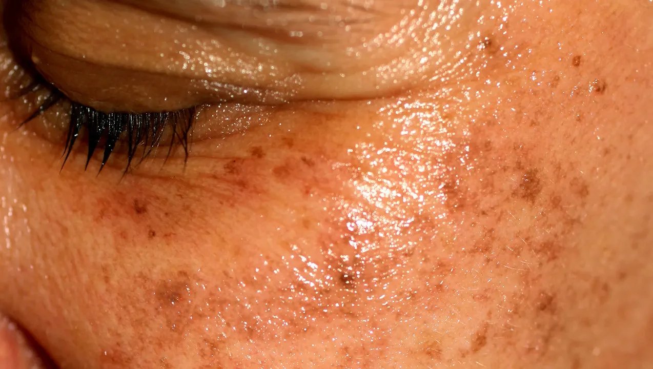 黄褐斑中医怎么治