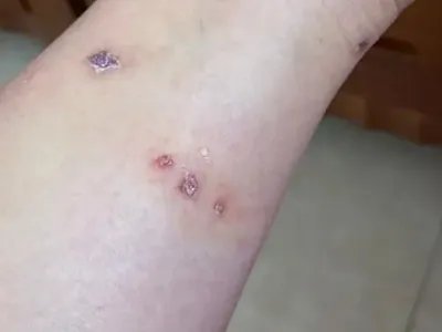 蠓虫叮咬引起的皮肤反应小腿结痂图片