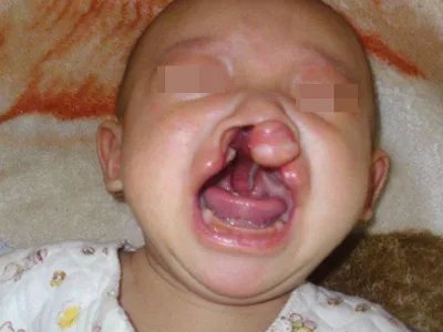 唇腭裂症状图片