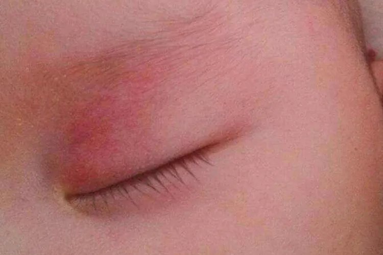 新生宝宝鹤吻痕图片