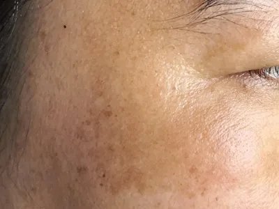 黄褐斑症状图片