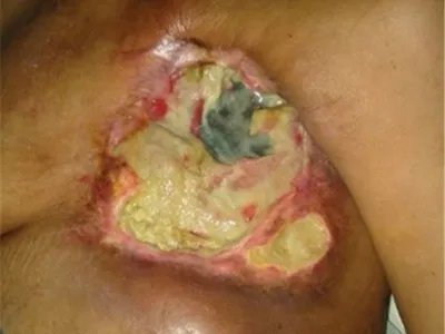 乳腺癌症状图片