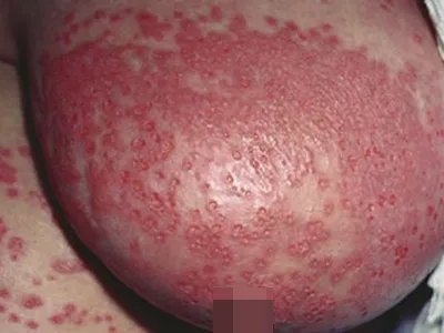 乳腺癌症状图片