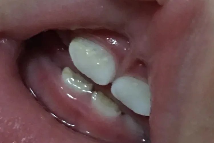 10个月宝宝龅牙图片