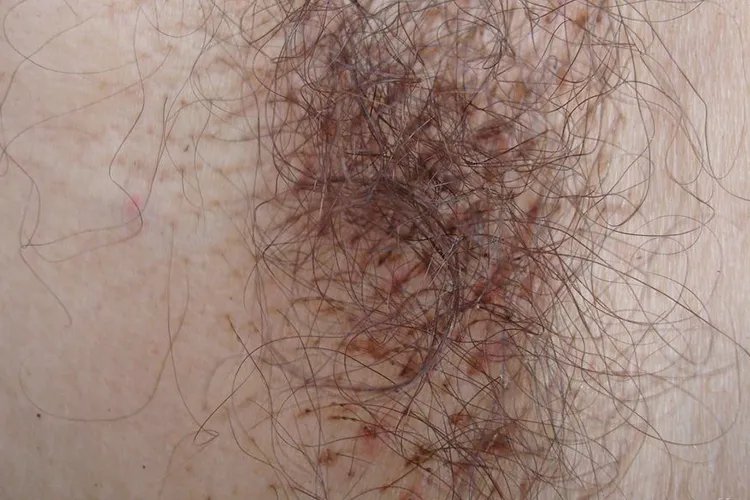 女性阴虱的症状图片