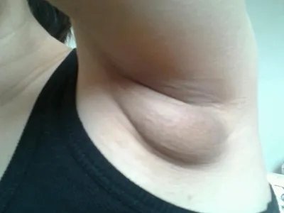 乳腺癌症状图片