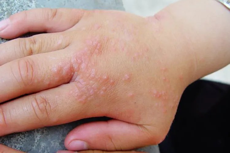 鹅掌风手癣图片