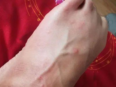 跳蚤叮咬疙瘩图片