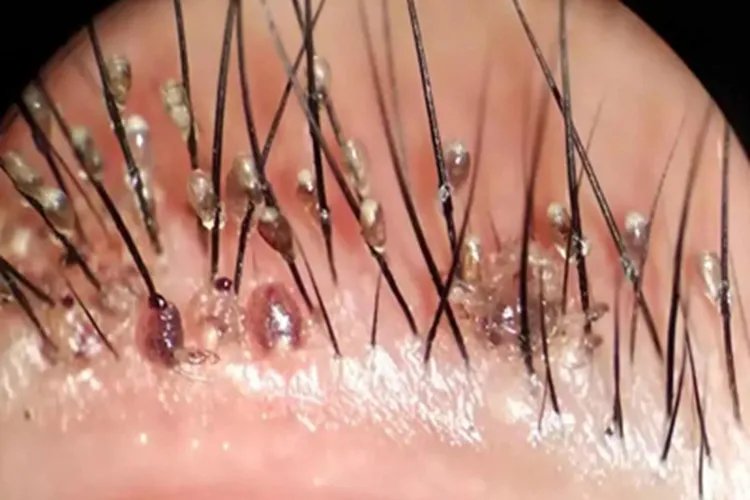 阴虱病症状图片