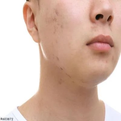 激光祛痘坑需要多少钱