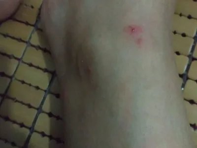 跳蚤叮咬疙瘩图片