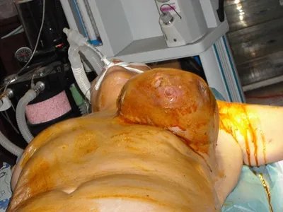 乳腺癌症状图片