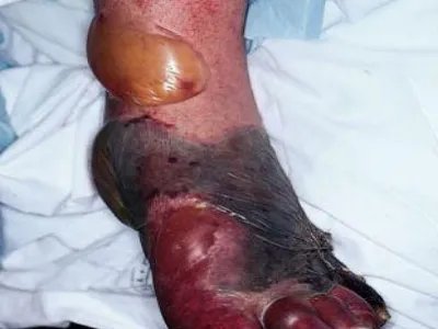 气性坏疽症状图片