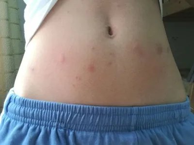 跳蚤叮咬疙瘩图片