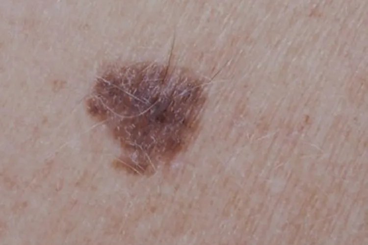 黑素瘤早期图片