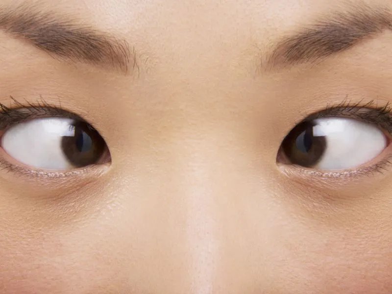 斗鸡眼会遗传吗