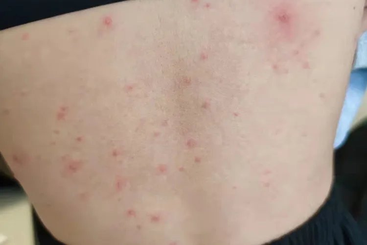 初期水痘的症状和治疗图片