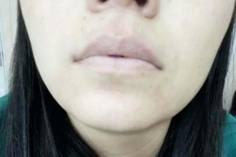 贫血严重会出现什么样的症状