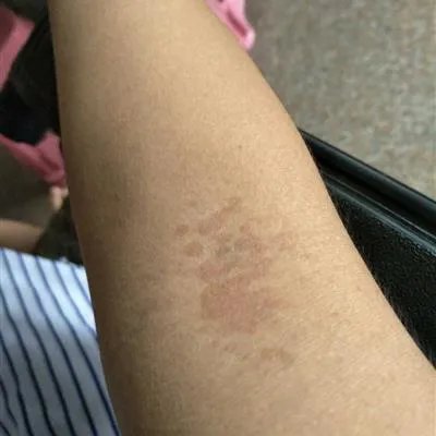 吃vb2后浑身搔痒是什么原因