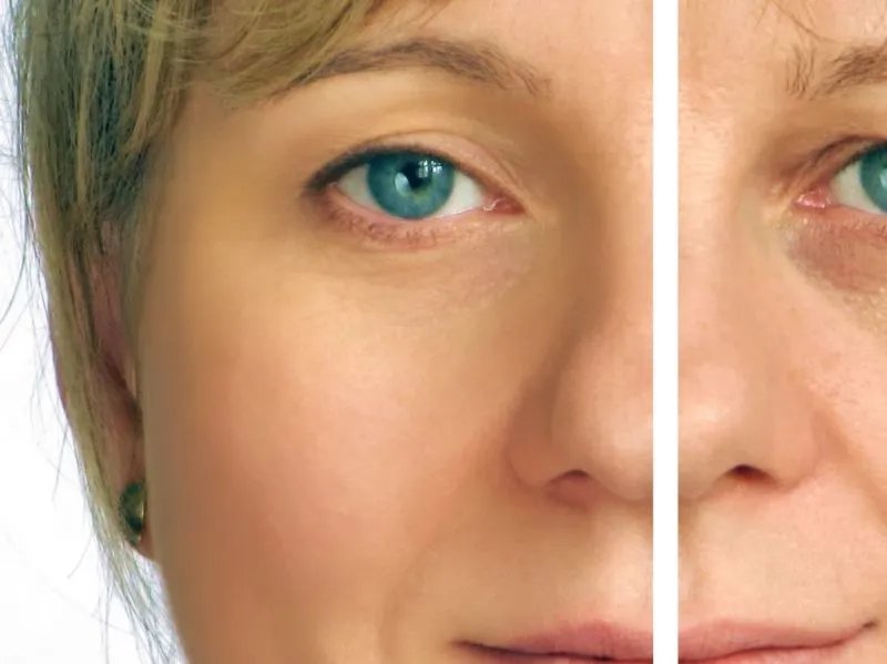 医学美容除皱术的方法