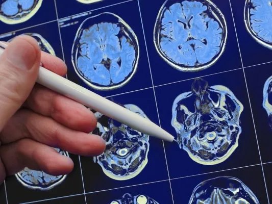 多发性脑梗塞是为什么