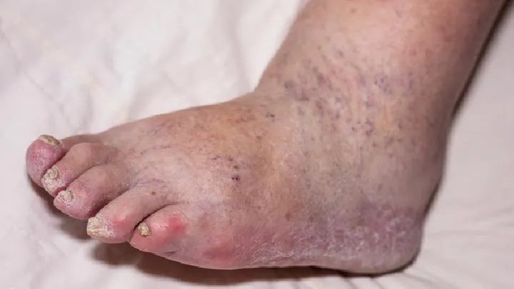 精索静脉曲张的危害有哪些？