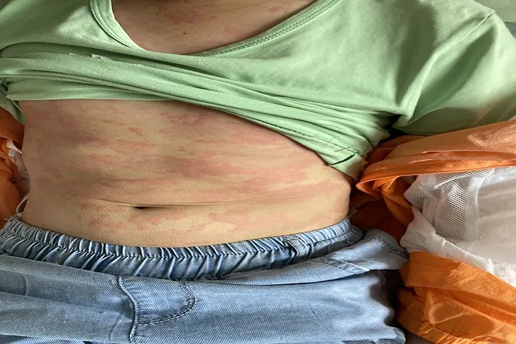 荨麻疹图片和症状图