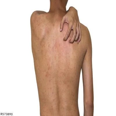 黑色素癌一般潜伏期有多长