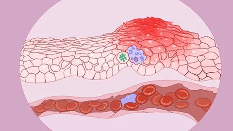 耳屎臭什么引起的
