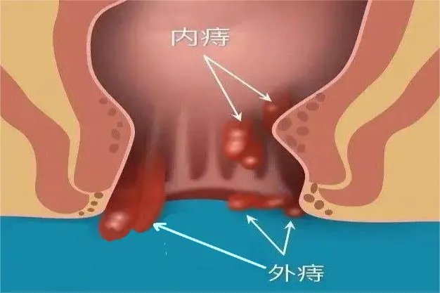 内痔外痔的图片