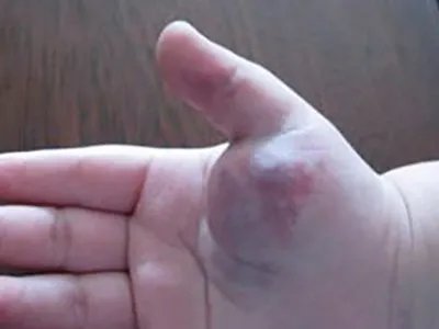 海绵状血管瘤手掌肿块图片