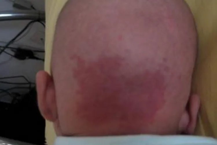 新生宝宝鹤吻痕图片