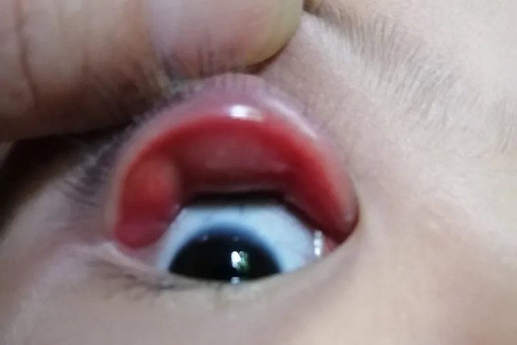 上眼皮内麦粒肿早期图片