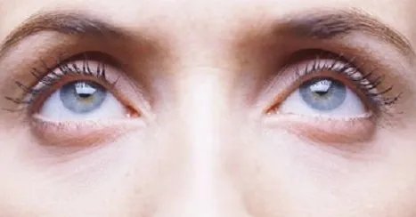 割眼袋手术有什么风险