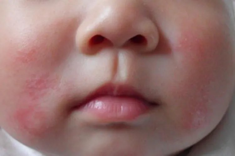 新生儿轻度奶癣图片