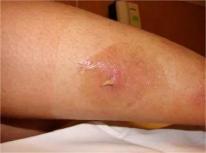 皮肤蝇蛆病症状图片