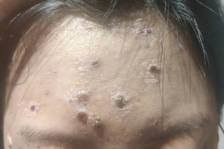 初期水痘的症状和治疗图片