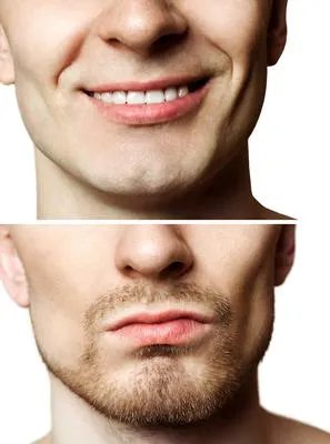 烂嘴角如何缓解 五个方法能缓解烂嘴角