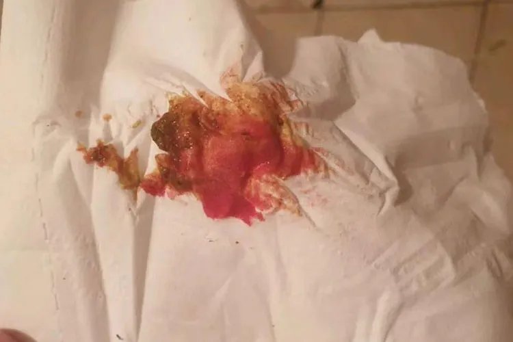 痔疮前期症状是什么样子的