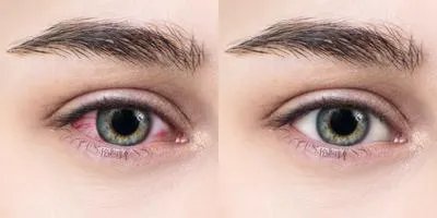 眼球充血怎么快速消除