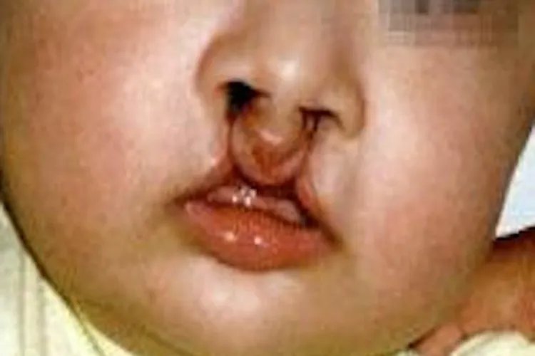 唇缺损裂口图片