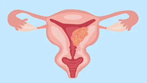 宫脱是怎么形成的