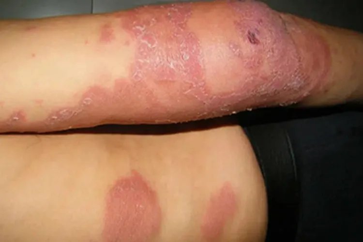 麻风病脱皮图片