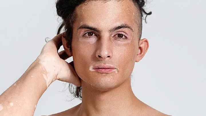 黄褐斑长得什么样