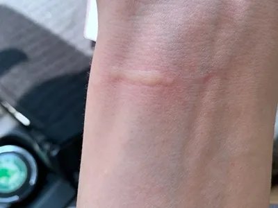 人工荨麻疹症状图片